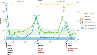 Diagnosis and treatment of liver metastases of parathyroid carcinoma